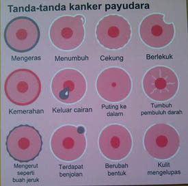 Tanda-tanda kanker payudara